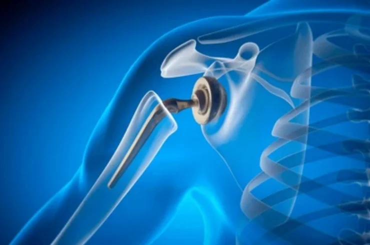 Shoulder replacement